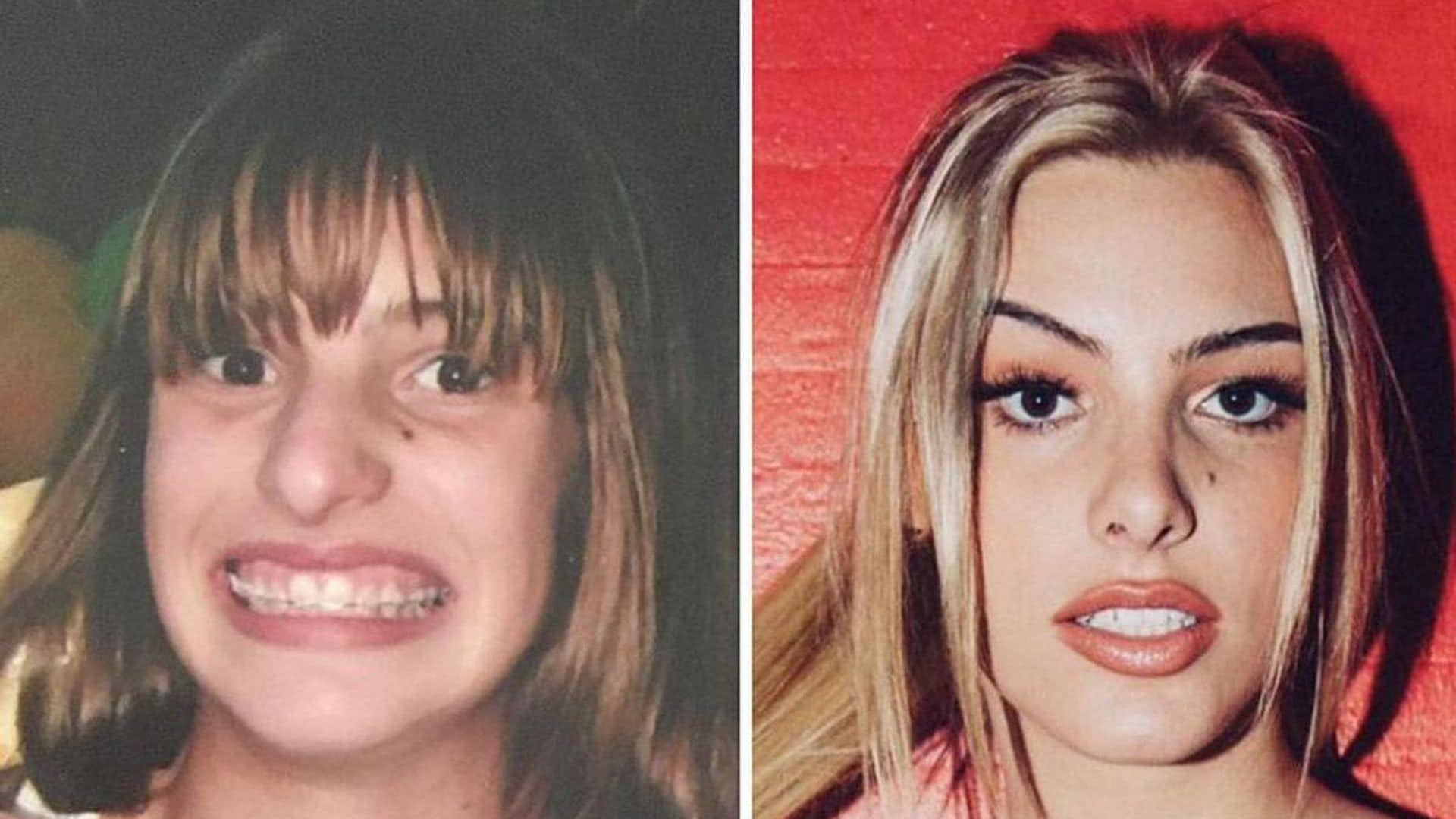 Lele Pons ‘exposes herself’ with adorable before and after rhinoplasty pics