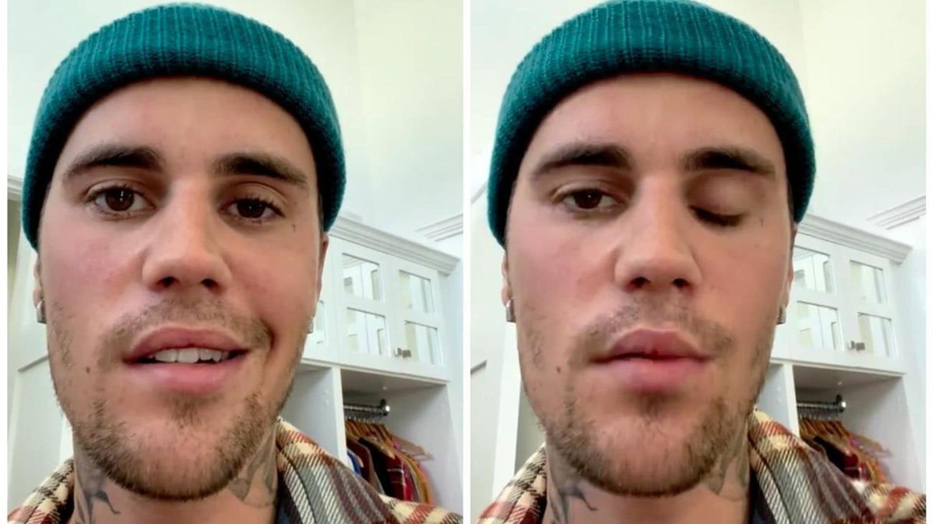 Justin Bieber has been diagnosed with Ramsay Hunt Syndrome; his face is partially paralyzed