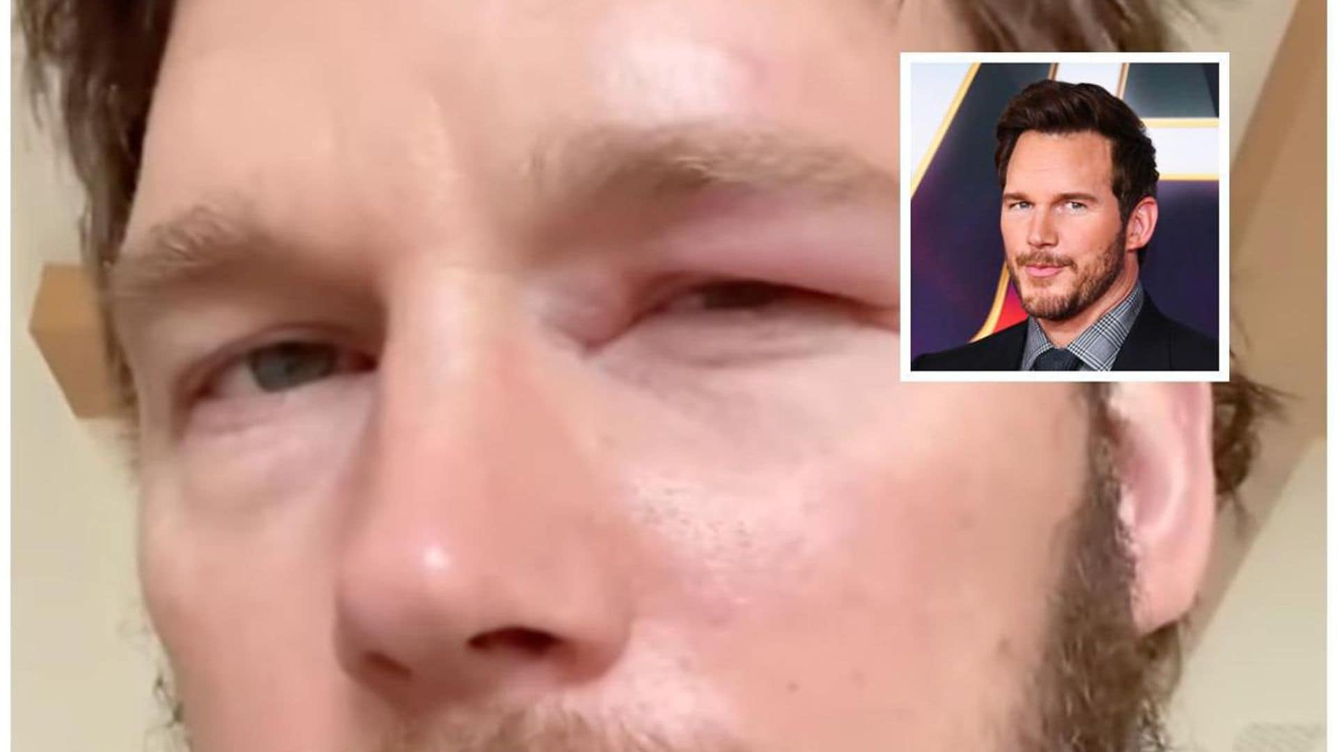 Chris Pratt will spend Christmas with a swollen eye after approaching a beehive