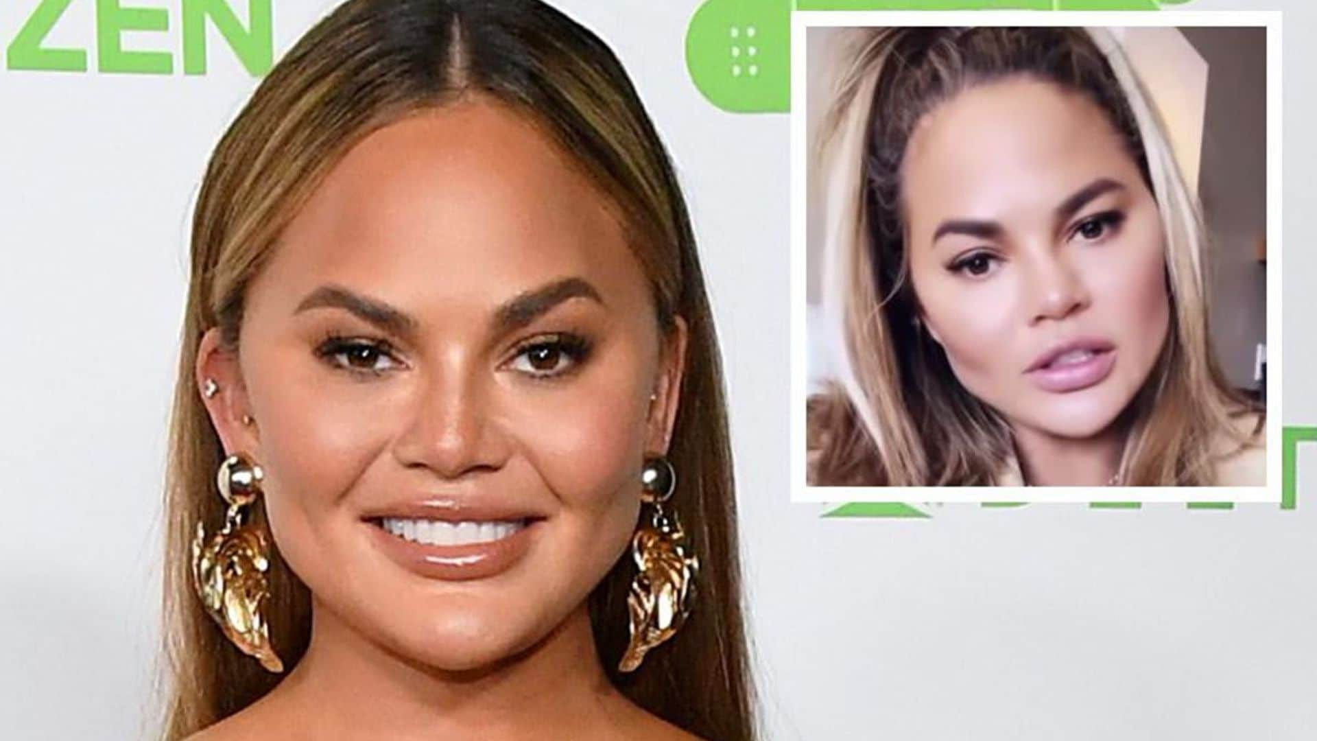 Chrissy Teigen has ‘no shame’ admitting she had cheek fat reduction surgery