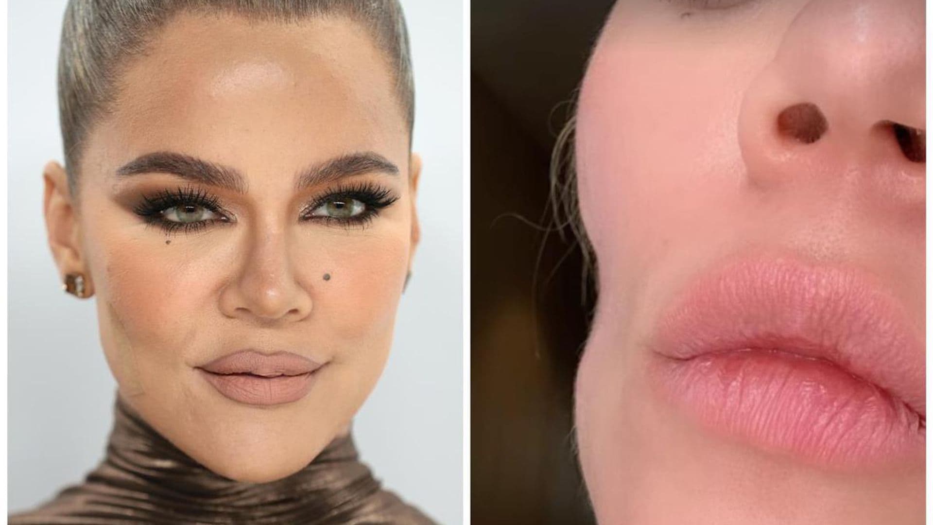 Khloé Kardashian discussed her journey with melanoma and her cheek indentation