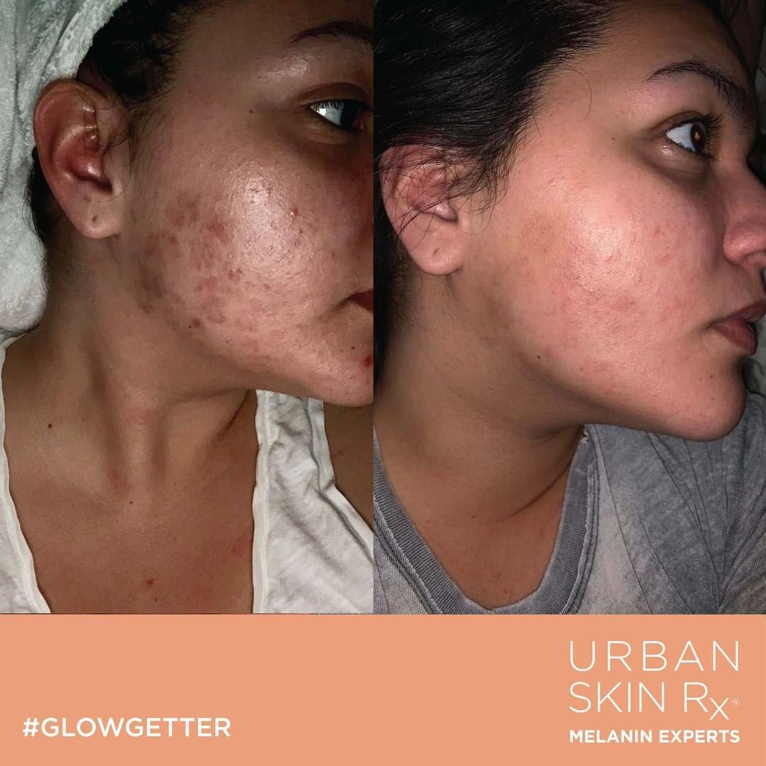 Urban Skin Rx before and after