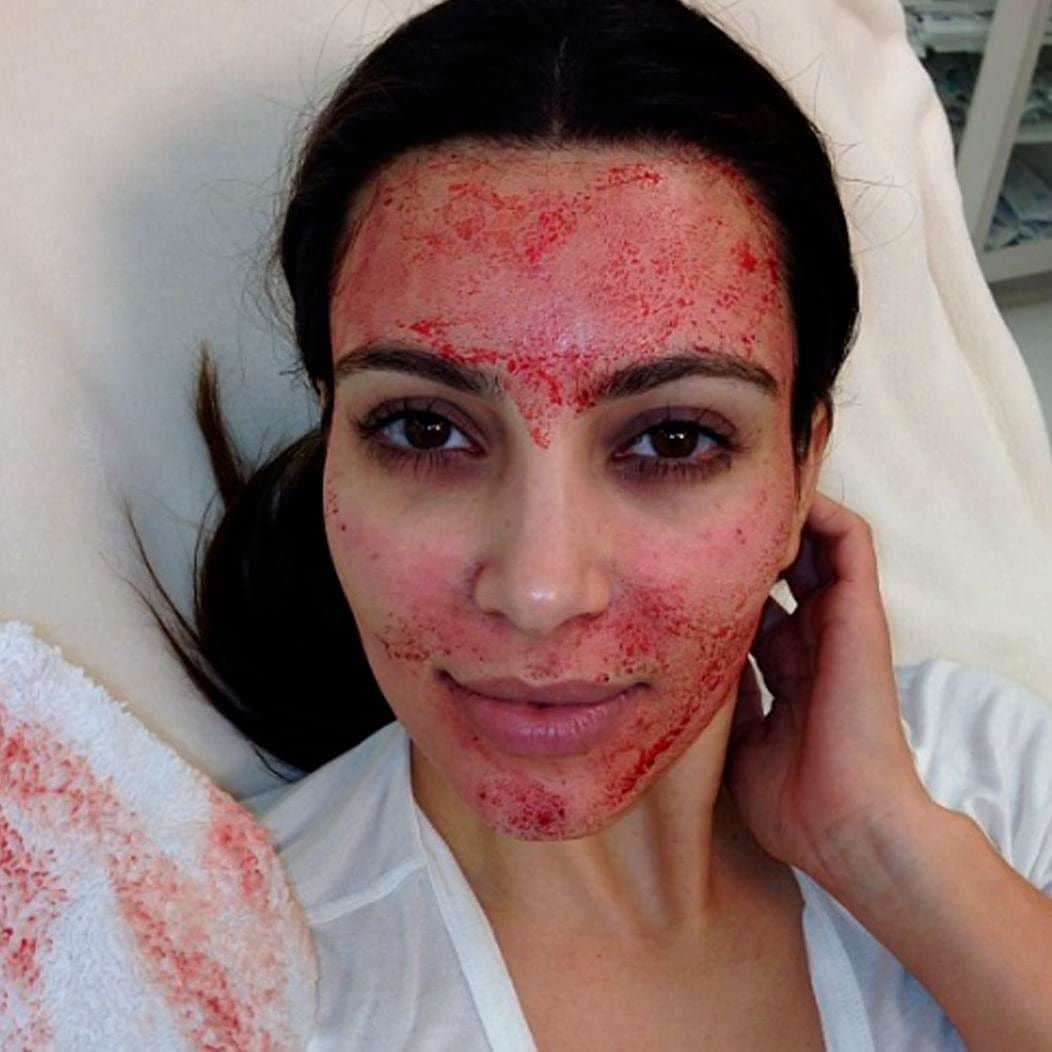 Kim Kardashian shows her vampire facial in a selfie