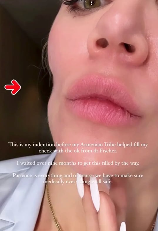 Khloe Kardashian is sharing her experience after undergoing surgery. 