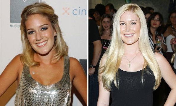 <b>Heidi Montag</b>
<br>
<i>The Hills</i> star has been frank about her changing appearance, telling <i>People</i> that she has undergone ten different cosmetic surgeries, starting when she was 17 years old.
</br><br>
Photo: Getty Images