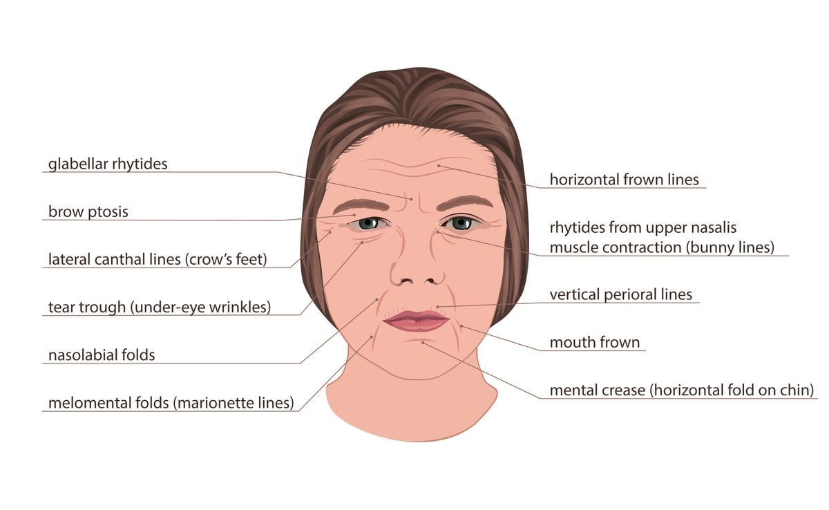 Illustration of the different types of wrinkles found on the face.