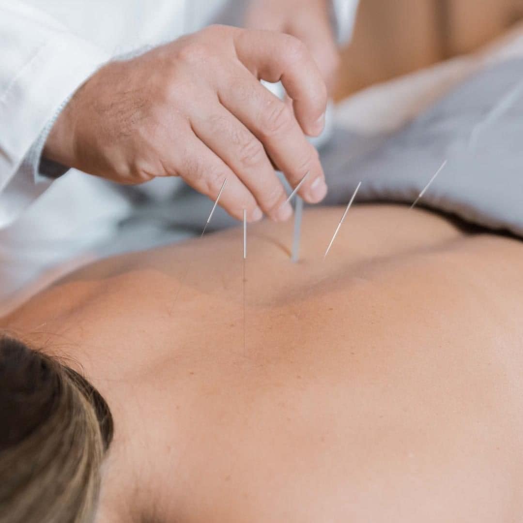 Acupuncture