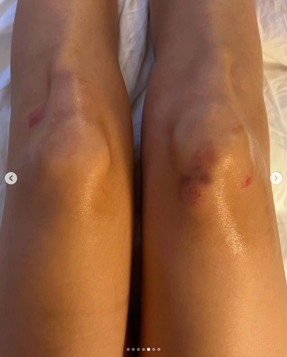 Belinda shows the bruises she suffered after falling during the L'Oréal fashion show