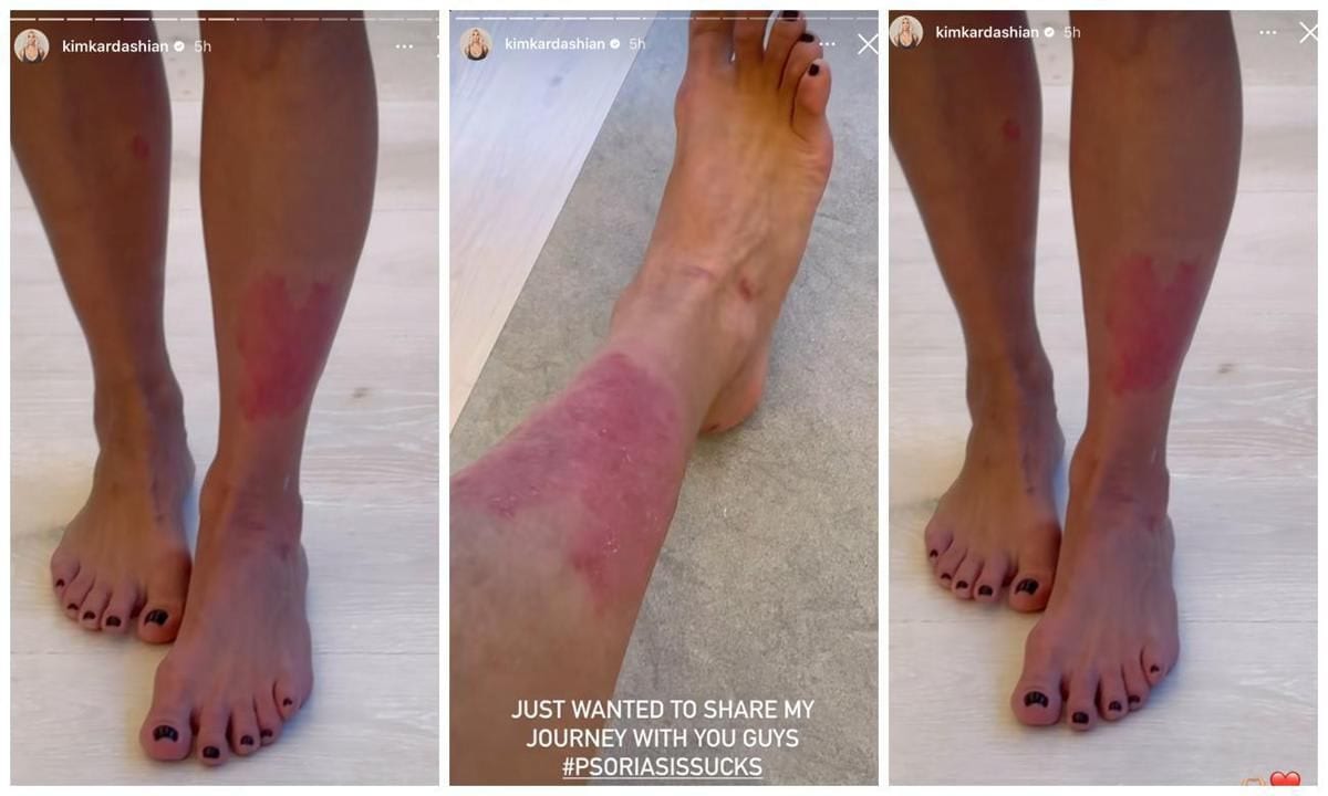 Kim Kardashian took to social media to share her struggles with psoriasis