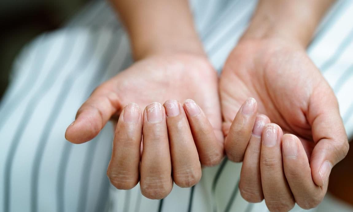 Fingers bent to reveal damaged nails