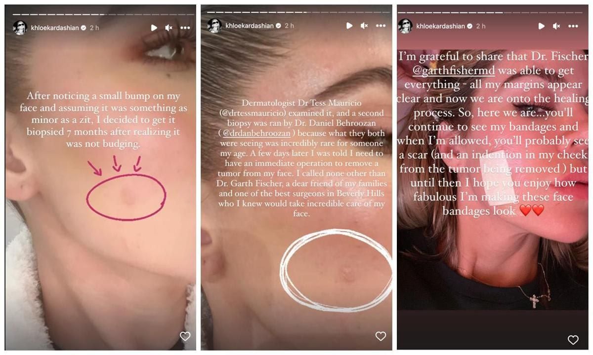 Khloé Kardashian skin cancer