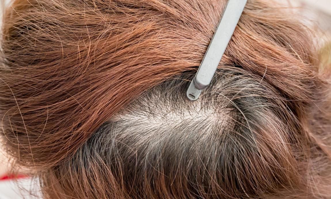 woman head with thinning hair, hair loss