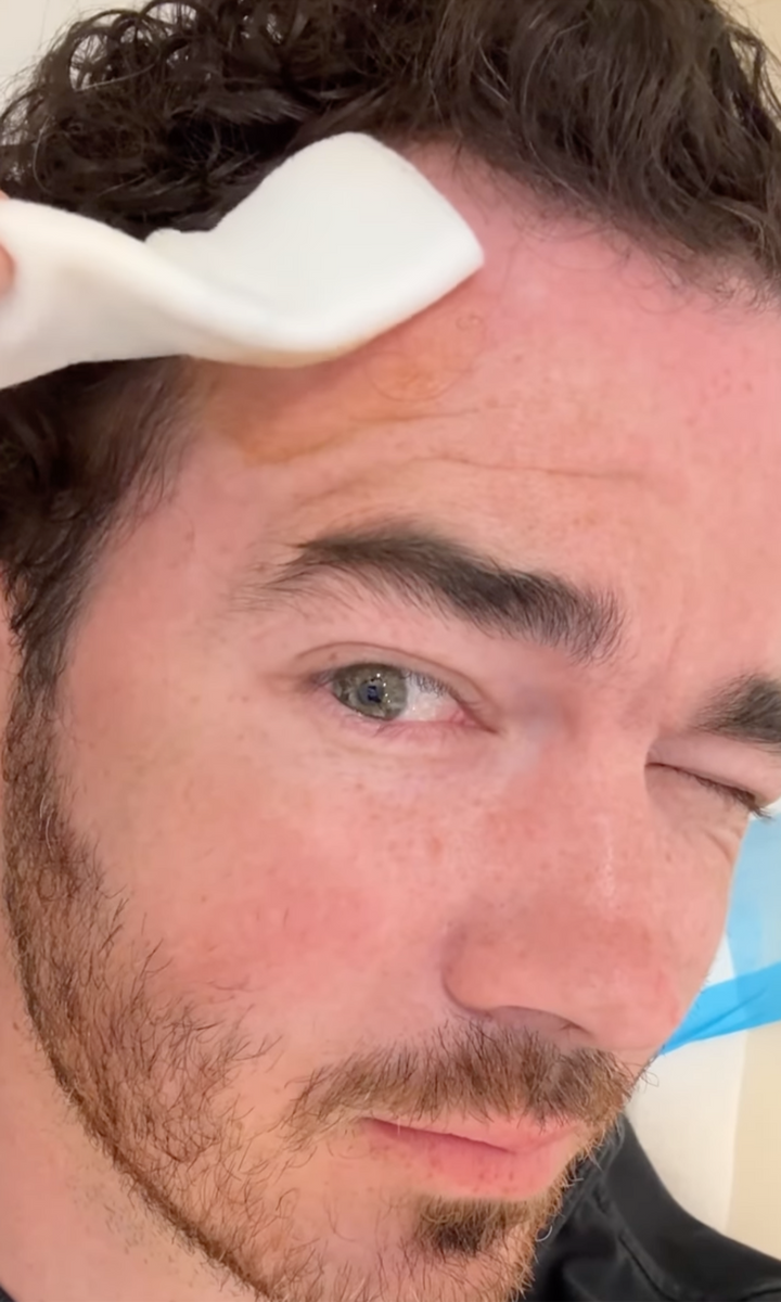 Kevin Jonas skin cancer