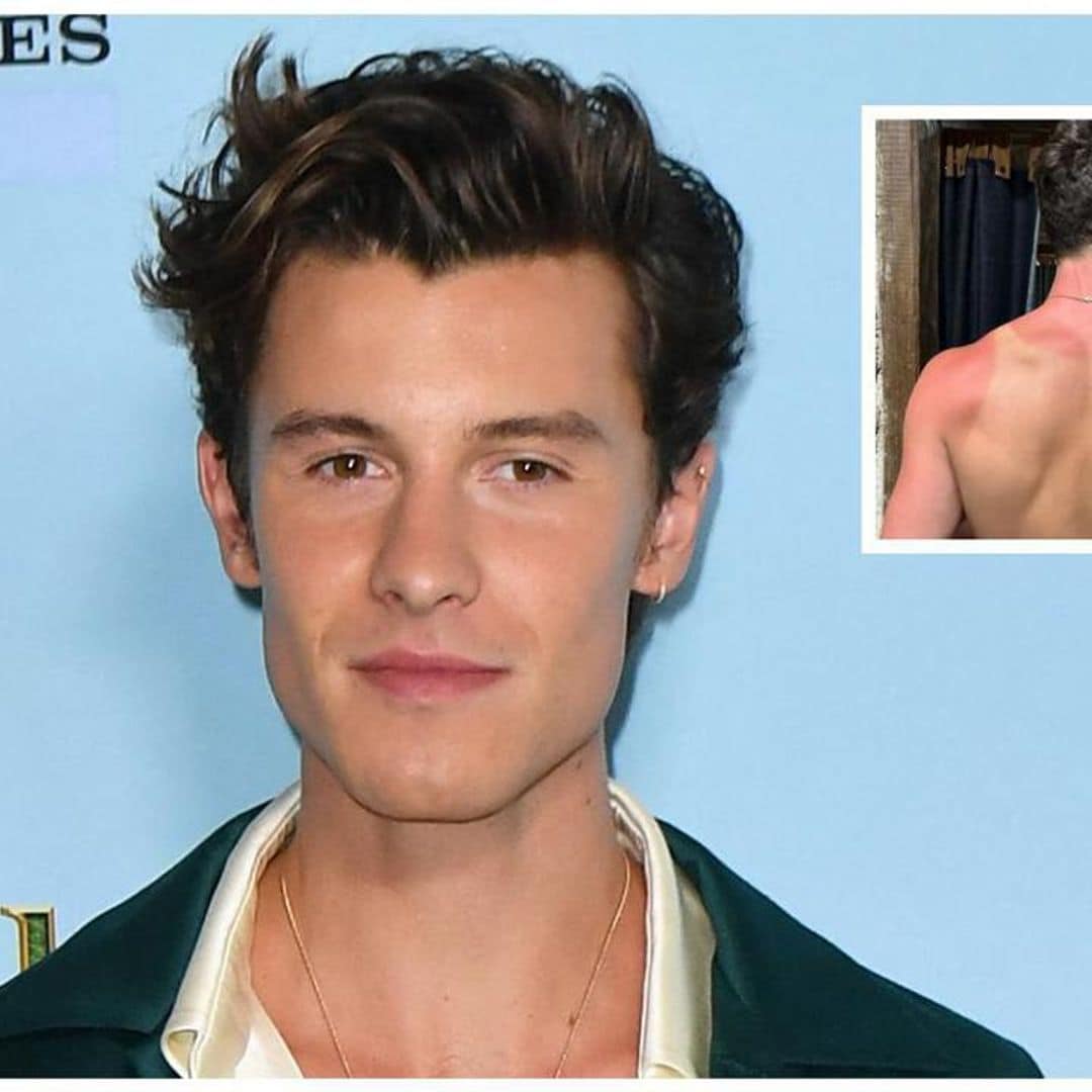 Shawn Mendes suffers burns on his back during his visit to the pyramids in Mexico