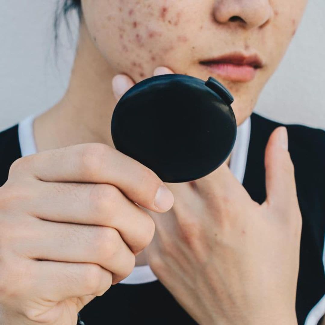 Skin expert explains what is hormonal acne and how to treat it