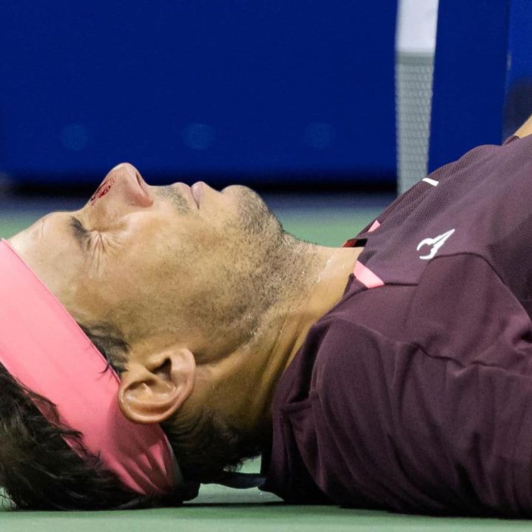 Rafael Nadal ended up with a bleeding nose after accidentally hitting himself during the U.S Open