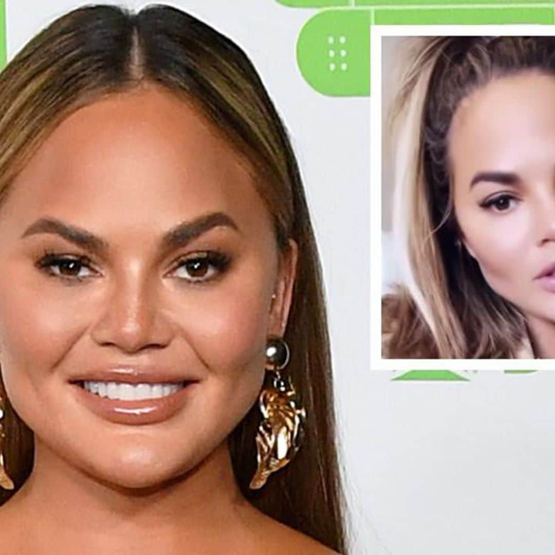 Chrissy Teigen has ‘no shame’ admitting she had cheek fat reduction surgery