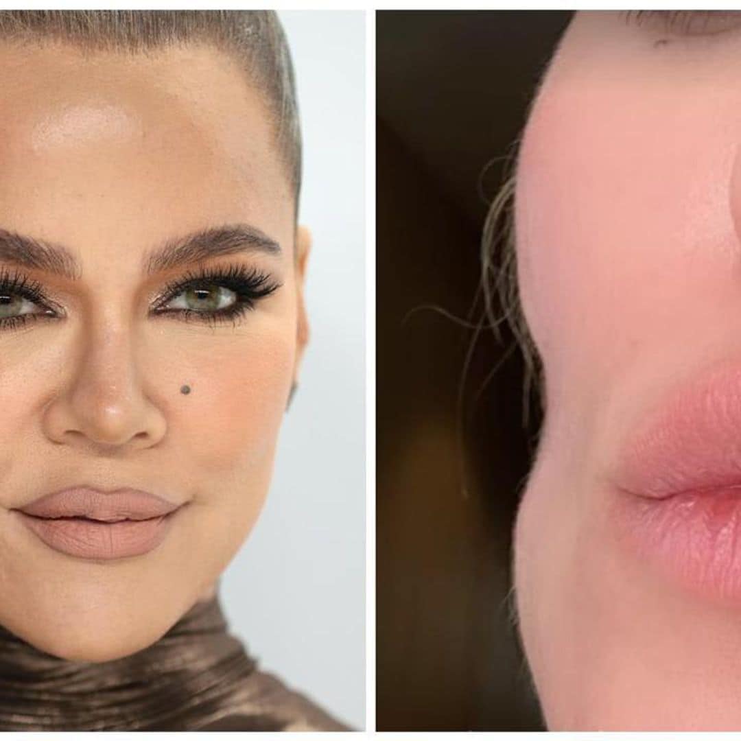 Khloé Kardashian discussed her journey with melanoma and her cheek indentation